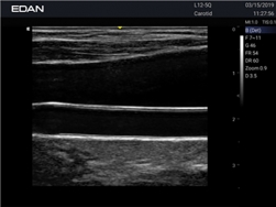 Edan Acclarix Ax2 Diagnostic Ultrason