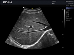 Edan Acclarix Ax2 Diagnostic Ultrason