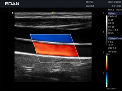 Edan Acclarix Ax2 Diagnostic Ultrason
