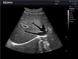 Edan Acclarix Ax2 Diagnostic Ultrason