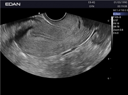 Edan Acclarix Ax2 Diagnostic Ultrason