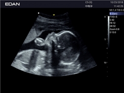 Edan Acclarix Ax2 Diagnostic Ultrason