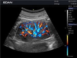 Edan Acclarix Ax2 Diagnostic Ultrason