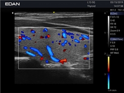 Edan Acclarix Ax2 Diagnostic Ultrason