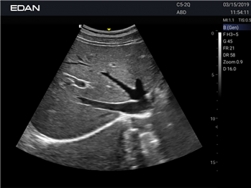 Edan Acclarix Ax3 Diagnostic Ultrason Cihazı