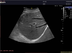 Edan Acclarix Lx9 Diagnostic Ultrason
